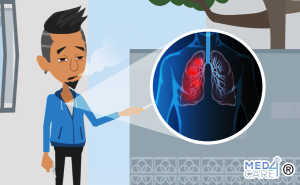 Scopri di più sull'articolo Tumore del polmone: il percorso diagnostico-terapeutico assistenziale.