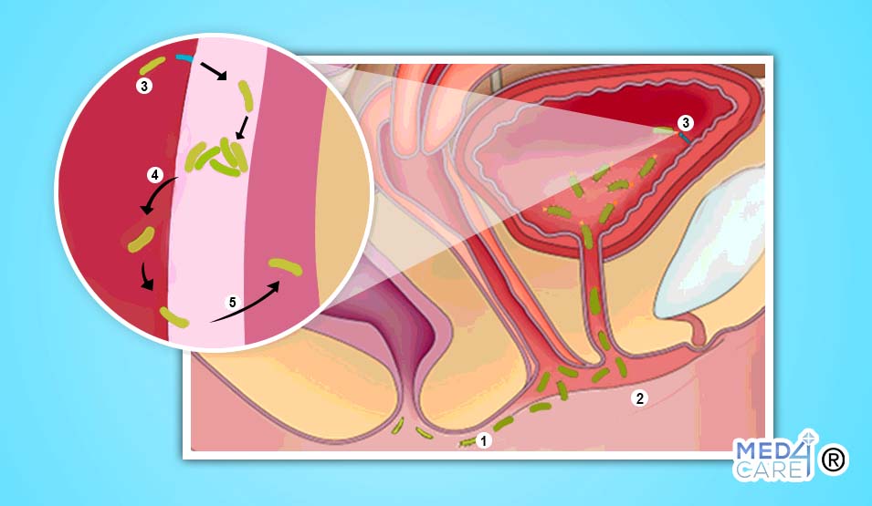 Prevenzione cistite: colonizzazione dei batteri nell'area urogenitale