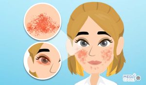 Scopri di più sull'articolo Rosacea o couperose: sintomi, cause, trattamento