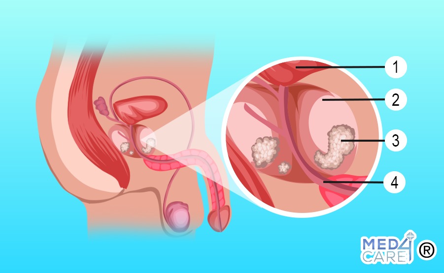 Tumore alla prostata