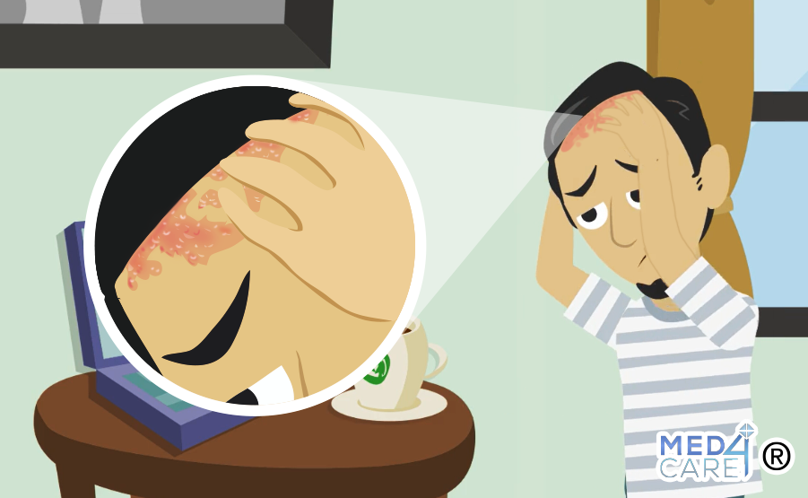 Dermatite seborroica sul cuoio capelluto