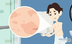 Scopri di più sull'articolo Lupus eritematoso sistemico (LES)