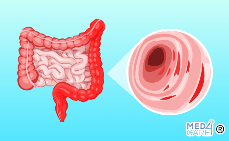 colite ulcerosa, colite, ulcera, sanguinamento, intestino