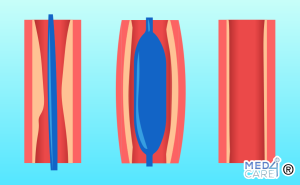 Scopri di più sull'articolo Angioplastica: preparazione, a cosa serve e come si esegue