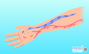 Scopri di più sull'articolo Fistola artero-venosa: cause, diagnosi e trattamenti
