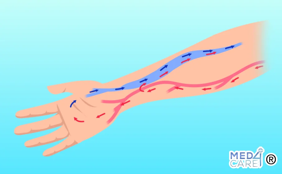 Fistola arterovenosa cause, diagnosi e trattamenti Med4Care