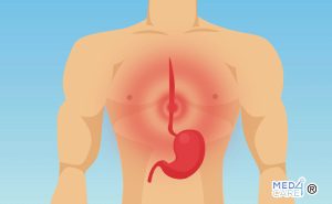 Scopri di più sull'articolo Pirosi: l’acidità di stomaco