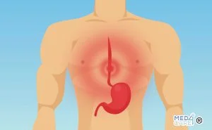 Scopri di più sull'articolo Pirosi: l’acidità di stomaco