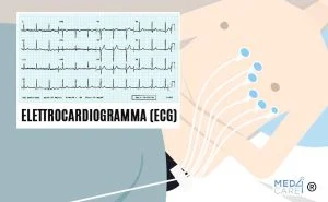 Elettrocardiogramma, ECG