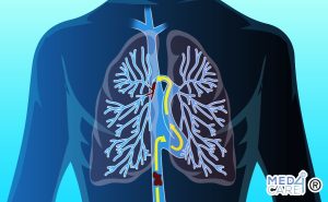 Scopri di più sull'articolo L’embolia polmonare: cause, sintomi e diagnosi