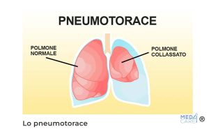 Pneumotorace