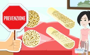 Scopri di più sull'articolo Prevenzione dell’osteoporosi