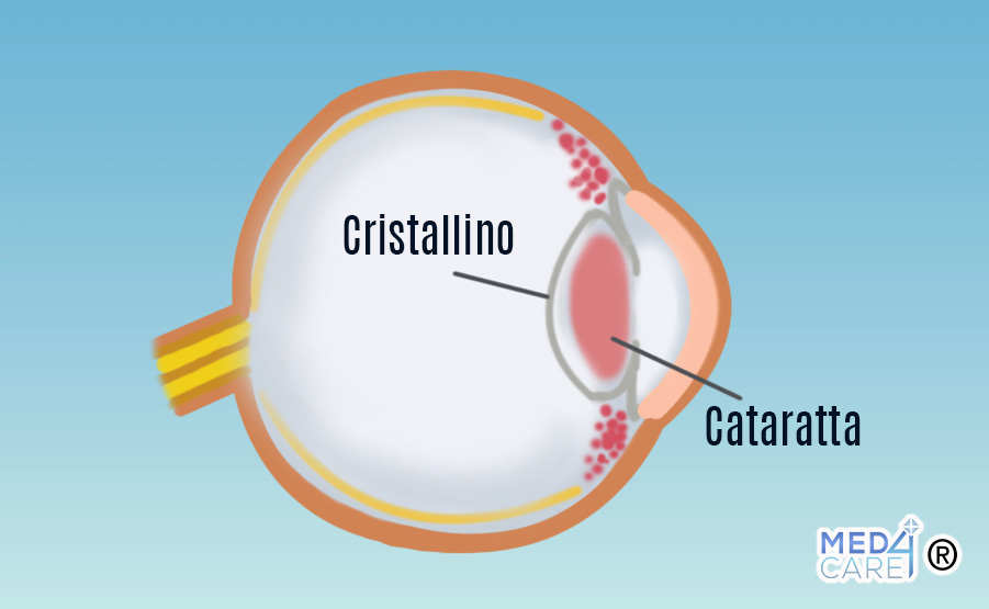 Cataratta, cristallino, occhio, oculistica