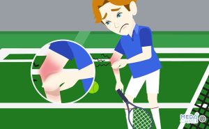 Epicondilite, gomito del tennista