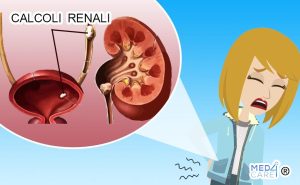 Scopri di più sull'articolo Rimozione endoscopica di piccoli calcoli renali asintomatici e rischio di recidive