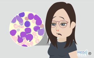 Scopri di più sull'articolo Leucemia linfoblastica acuta (LLA)