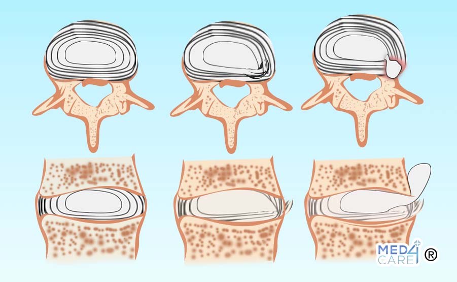 Ernia lombare, ernia contenuta, ernia espulsa, ernia migrata