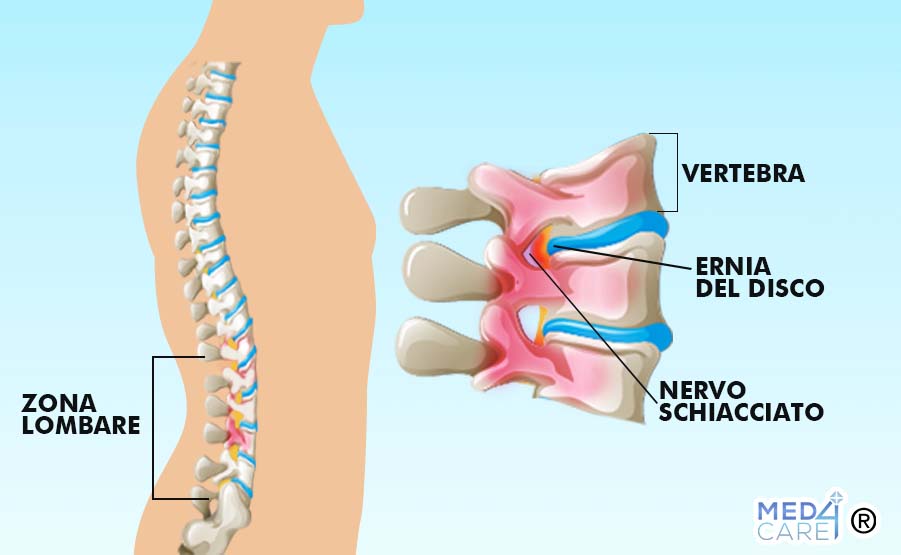 Ernia lombare, ernia del disco, zona lombare, nervo schiacciato