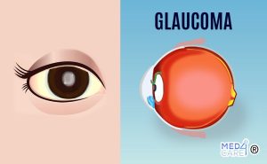 Scopri di più sull'articolo Glaucoma