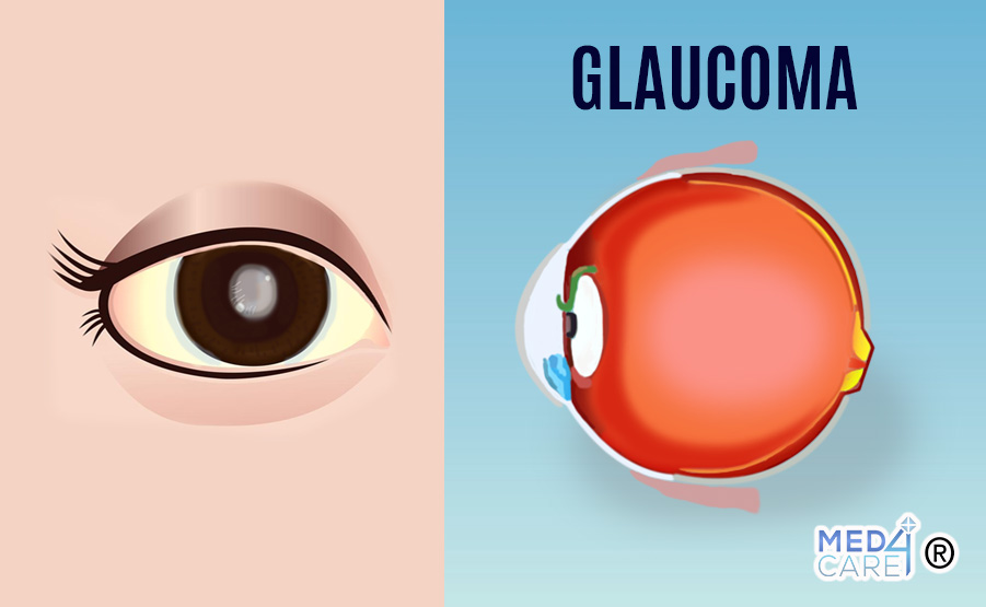 Glaucoma, malattie dell'occhio