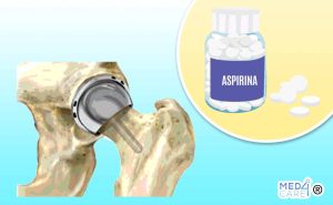 Scopri di più sull'articolo Efficacia dell’aspirina nel prevenire il TEV dopo l’artroplastica