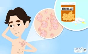 Scopri di più sull'articolo Apremilast: è abbastanza efficace per curare la psoriasi?