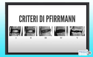 Criteri di Pfirrmann