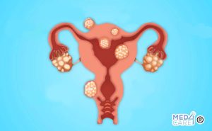 Scopri di più sull'articolo Fibromi uterini