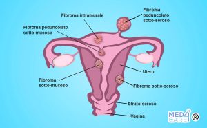 Fibromi uterini, fibroma sotto-mucoso, fibroma sotto-seroso, fibroma peduncolato, fibroma intramurale