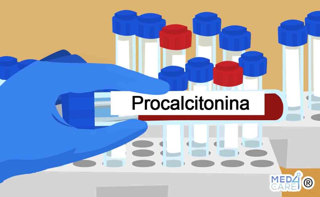 Procalcitonina, esami di laboratorio
