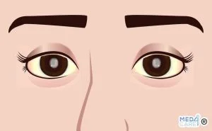 Scopri di più sull'articolo Glaucoma: prevenzione e fitoterapici utili