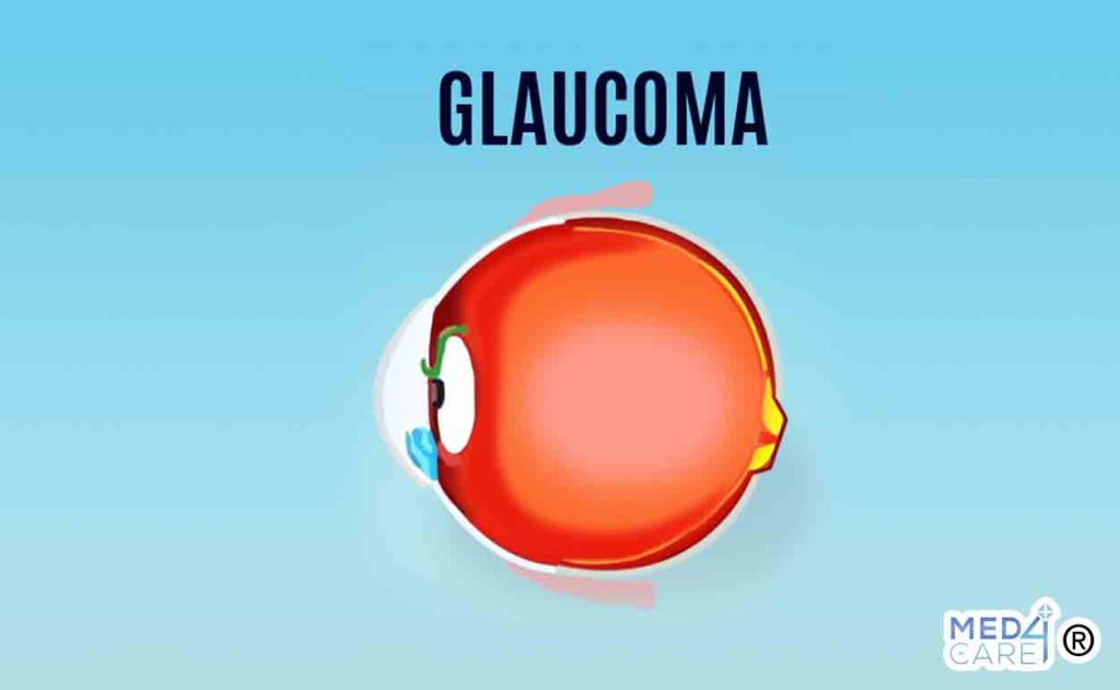 Glaucoma