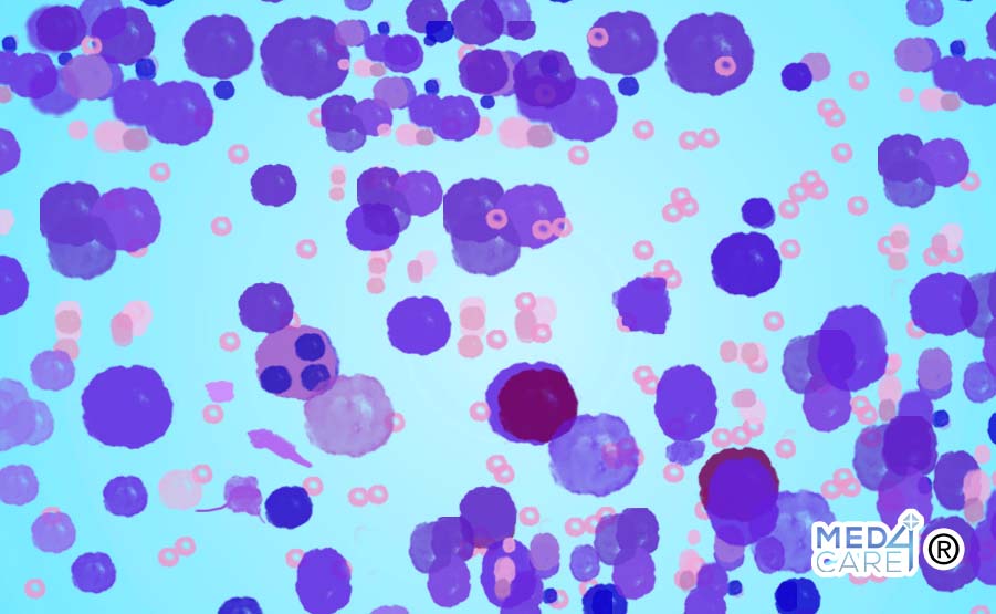 Leucemia mieloide cronica, leucemie