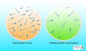 Scopri di più sull'articolo Oligospermia: una ridotta quantità di spermatozoi