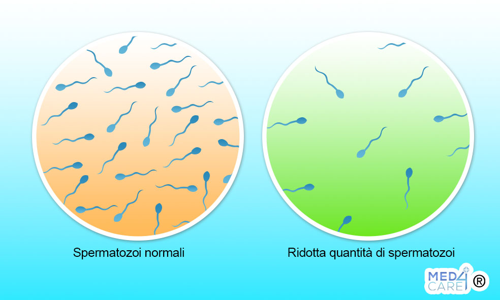 oligospermia, quantità ridotta di spermatozoi