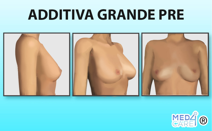 Additiva Grande prima, mastoplastica additiva