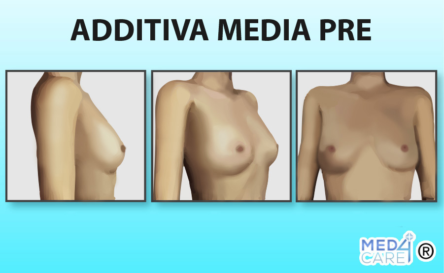 Additiva Media prima, mastoplastica additiva