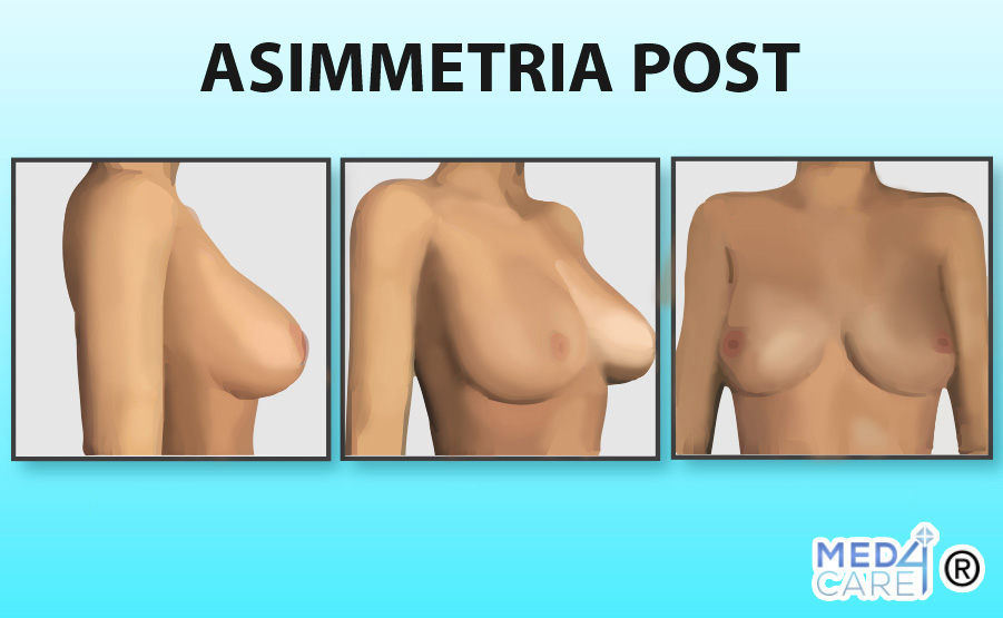 Asimmetria dopo, mastoplastica additiva