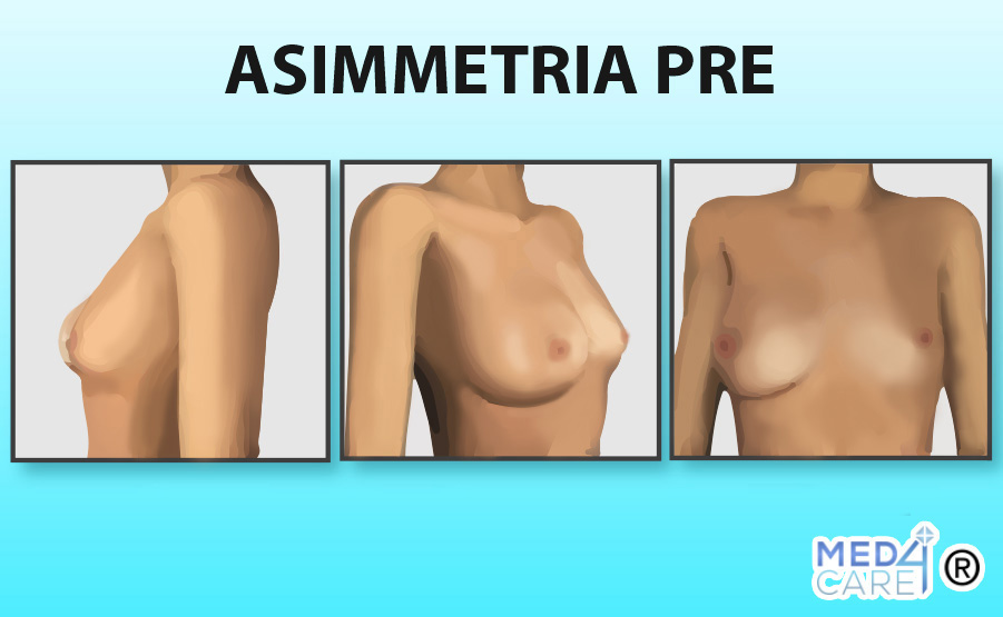 Asimmetria prima, mastoplastica additiva