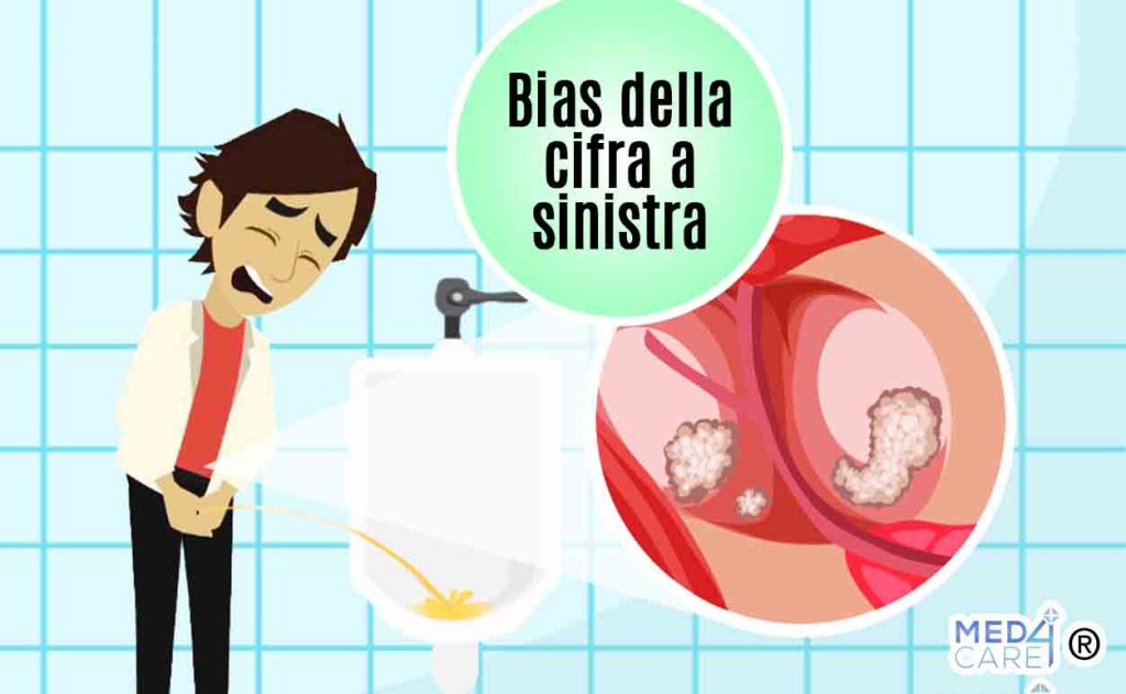 Bias della cifra a sinistra e cancro alla prostata