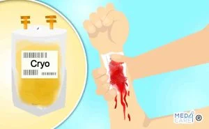 Scopri di più sull'articolo Crioprecipitato nelle emorragie gravi: è efficace?