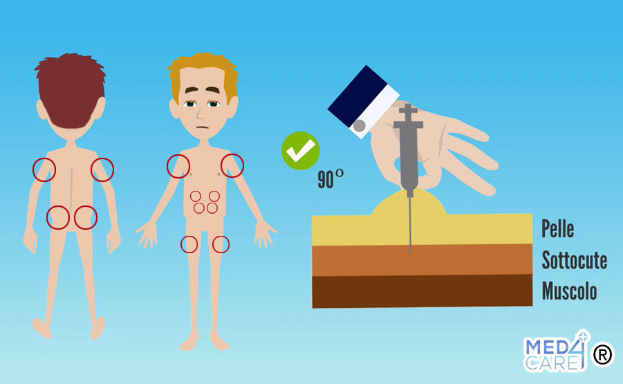 Tecnica per iniezione sottocutanea