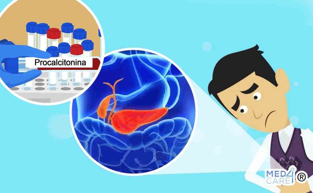 Procalcitonina e pancreatite acuta