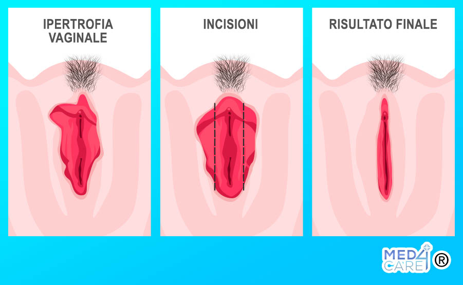 Tecnica di labioplastica, labioplastica