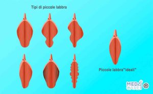 Tipi di piccole labbra, labioplastica