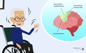 Scopri di più sull'articolo Parkinson: il ruolo della corteccia motoria e della sostanza bianca