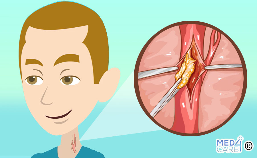 Stenosi carotidea e sanguinamento post-operatorio