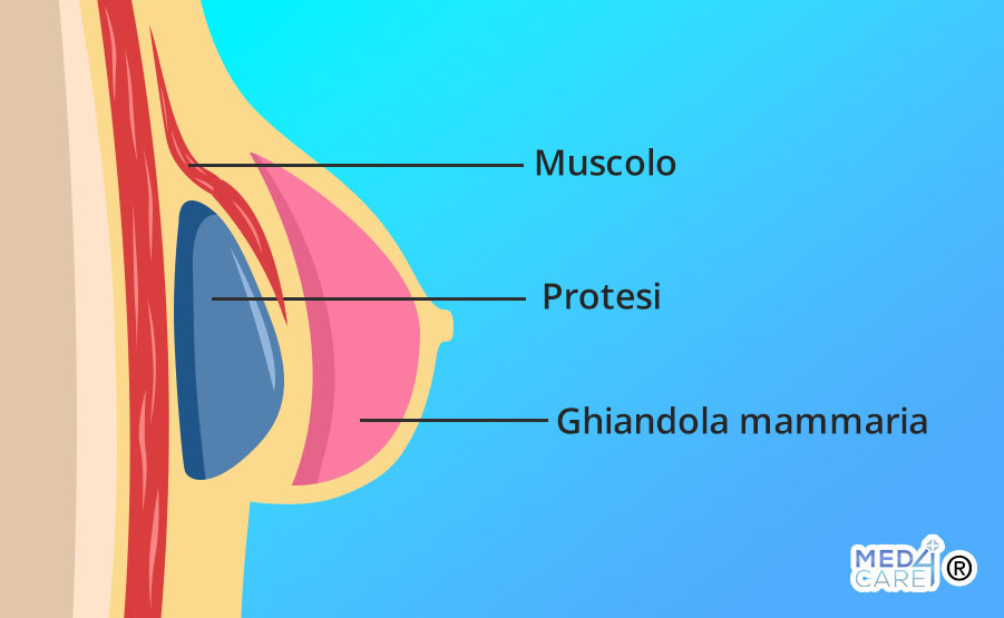 Mastoplastica additiva dual plane, mastoplastica additiva, tecnica retromuscolare