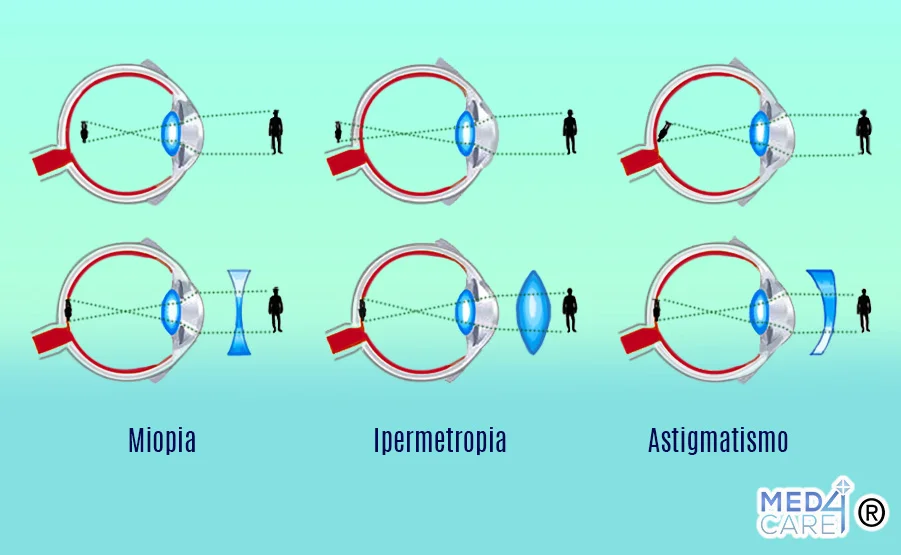 Miopia, astigmatismo, ipermetropia, ametropie
