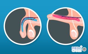 Scopri di più sull'articolo Rimedi per la disfunzione erettile